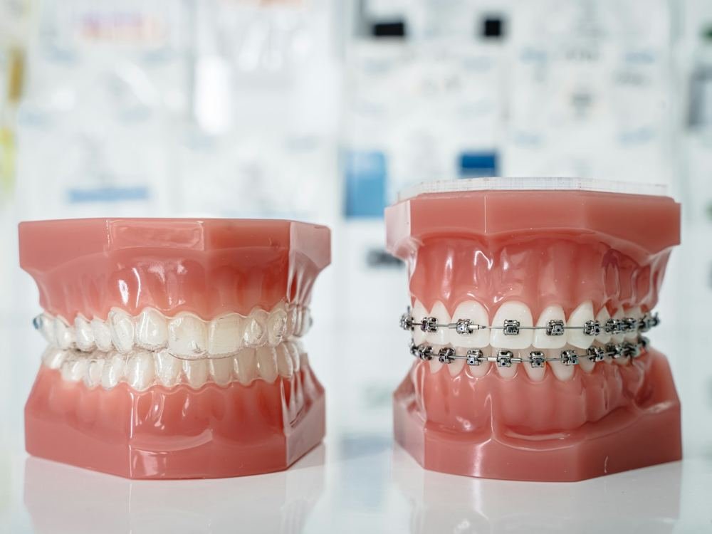 Orthodontics Braces Kids Dombivli Palava